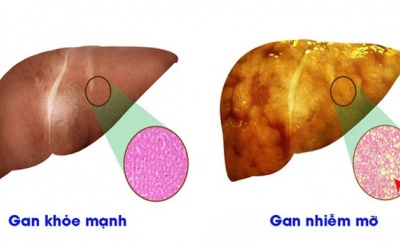 Gan nhiễm mỡ có mấy cấp độ, cấp độ nào nguy hiểm nhất?