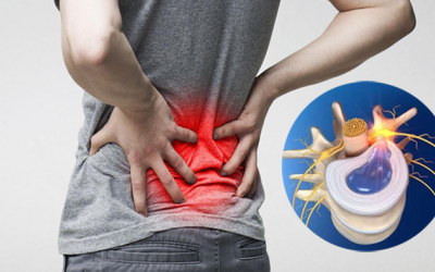 Dấu hiệu nhận biết thoát vị đĩa đệm L4-L5 