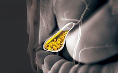 Sỏi bùn chiếm 1/3 túi mật, dùng TPBVSK Kim Đởm Khang còn tốt không?