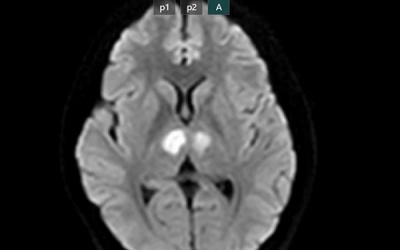 Tổn thương não, bất tỉnh sau khi uống thuốc '7 ngày giảm 7kg' trên mạng