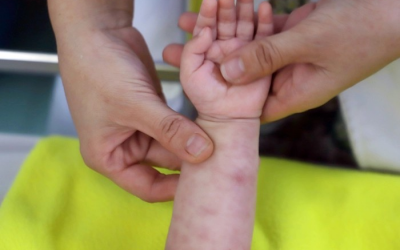 2 trẻ tử vong sau sốt phát ban ở Quảng Nam, Bộ Y tế cảnh báo dịch sởi