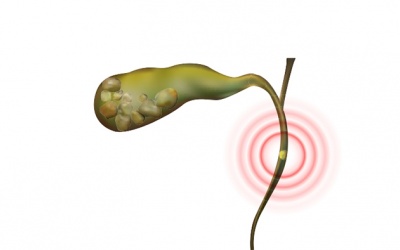 Tái phát sỏi ống mật chủ 13mm sau mổ phải làm sao?