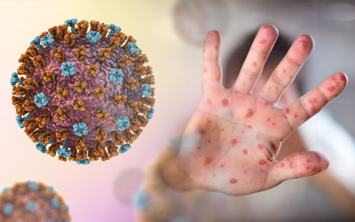 Không chủ quan với sự trở lại của bệnh sởi