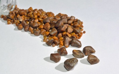 Sự khác biệt giữa sỏi mật cholesterol và sỏi mật sắc tố