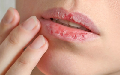 Bị khô môi là do thiếu đi những dưỡng chất nào?
