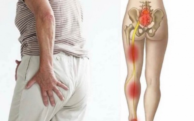 Cách phòng ngừa bệnh đau thần kinh tọa