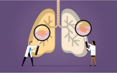 Thuốc lá không phải là nguyên nhân duy nhất gây ung thư phổi