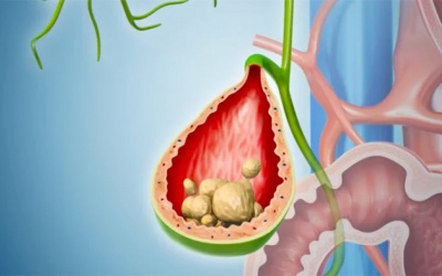 Những điều bạn cần biết khi có sỏi túi mật 6mm
