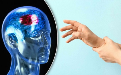 Run tay chân sau đột quỵ có nguy hiểm không?