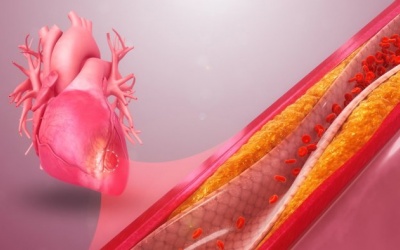 Hẹp mạch vành 70%, chưa đặt stent có nguy hiểm không?