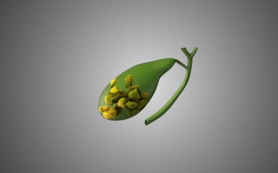 Sỏi bùn mật có thể chuyển thành dạng viên không?