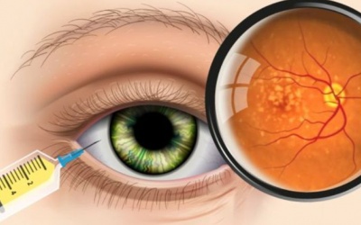 Bệnh viện nào ở Hà Nội tiêm nội nhãn võng mạc đái tháo đường?