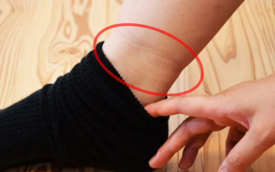 Vết tất hằn trên chân cảnh báo nhiều vấn đề sức khỏe