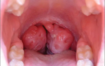 Viêm amidan quá phát ở trẻ và những biến chứng nguy hiểm