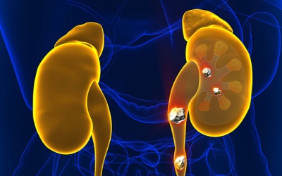 Tán sỏi thận qua nội soi niệu quản ngược dòng như thế nào?