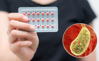 Thường xuyên dùng thuốc tránh thai có làm tăng nguy cơ sỏi mật?
