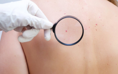 Có thể sàng lọc ung thư da bằng hình ảnh 3D?