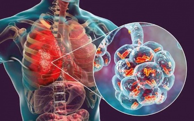 Bộ Y tế thông tin về bệnh hô hấp chưa rõ nguyên nhân tại Nga