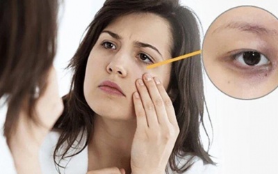 Uống ít nước có thể gây quầng thâm mắt