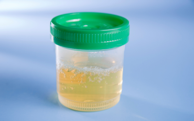 Nước tiểu có bọt có phải là dấu hiệu cảnh báo bệnh thận?