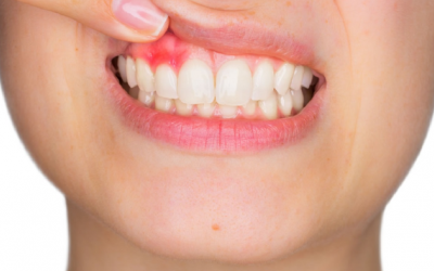 Chu kỳ kinh nguyệt ảnh hưởng thế nào tới sức khoẻ răng miệng?