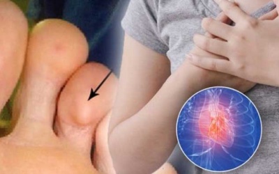 3 dấu hiệu ở bàn chân cảnh báo bệnh tim 