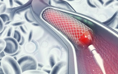 Tại sao hẹp mạch vành 50% đã phải đặt stent? 