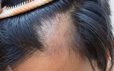 Mẹo làm đẹp giúp người bị rụng tóc từng mảng lấy lại tự tin