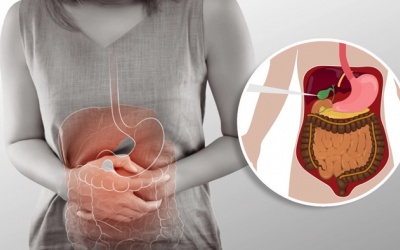 Làm thế nào để hết đau bụng, khó tiêu do sỏi mật 8mm?