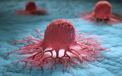 “Điểm danh” các loại ung thư đang gia tăng trước tuổi 50 