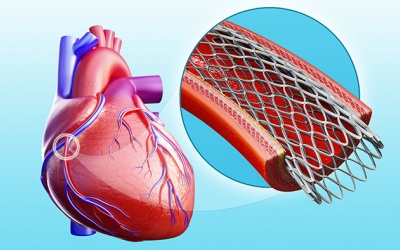 Chi phí phẫu thuật nong mạch vành hết bao nhiêu tiền?