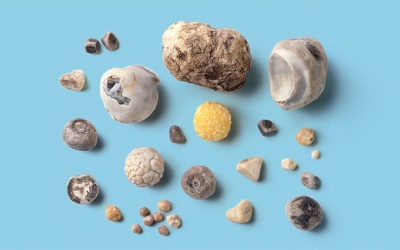 Sỏi mật 8,9mm nhưng chưa biến chứng có nguy hiểm không?