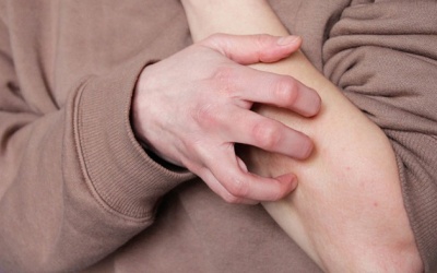 Làm thế nào để giảm ngứa do mề đay mạn tính hiệu quả? 