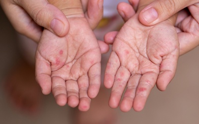 Cách phòng bệnh tay chân miệng mùa Hè