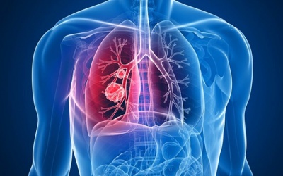 Tác động của hóa trị và xạ trị với người bệnh ung thư phổi