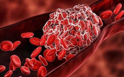 Nguyên nhân hình thành cục máu đông: Hiểu để chủ động phòng ngừa!