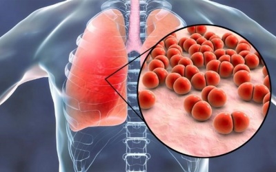 Các bệnh do phế cầu khuẩn ngày càng tăng, diễn biến khó lường