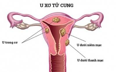 U xơ tử cung dưới niêm mạc có nguy hiểm không?