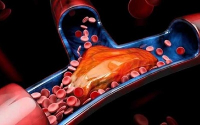 Làm thế nào để phòng ngừa cục máu đông?