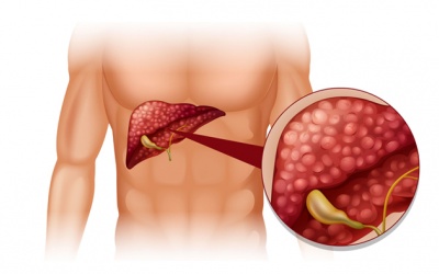 Chi phí tán sỏi mật qua da tại bệnh viện như thế nào?