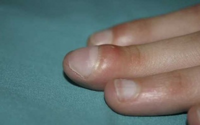 Dấu hiệu ở đầu ngón tay cảnh báo bệnh phổi 