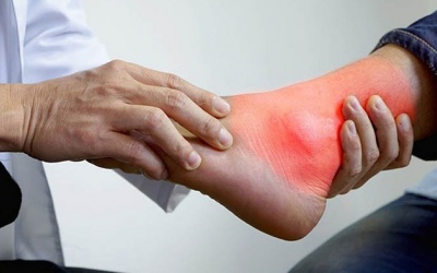 Chế độ ăn cho người bị đau gout cấp: Nên ăn và kiêng gì?