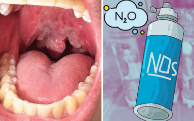 Cảnh báo nguy cơ bỏng lạnh khi lạm dụng khí N2O