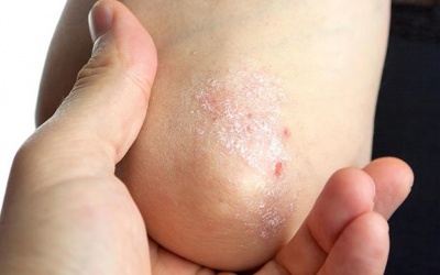 Hiểu về bệnh vảy nến và cách điều trị