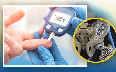 Đái tháo đường và loãng xương có mối liên hệ gì?