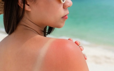 Mách bạn cách cải thiện cháy nắng hiệu quả