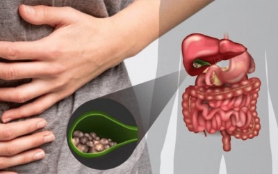 Có sỏi bùn túi mật 15mm cần xử trí thế nào?