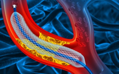 Đặt stent 2 tháng vẫn nhói ngực và mệt phải làm sao?