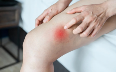 5 cách để giảm ma sát và bảo vệ da khi chơi thể thao