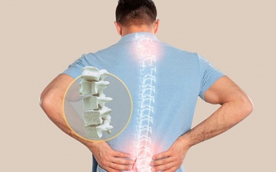 Ứng dụng công nghệ sinh học trong điều trị loãng xương mức độ nặng